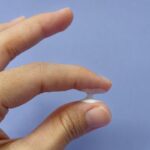Líquen escleroso vulvar